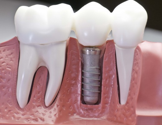 Имплантация зубов vs протезирование