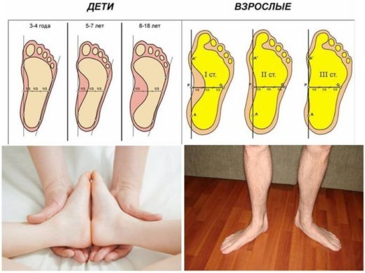 Как подобрать ортопедическую обувь для детей в Новосибирске и не только
