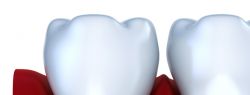 Имплантация стала уже хорошо отработанной технологией восстановления зубов