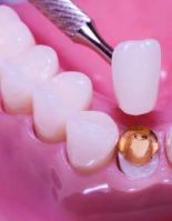 Ультратонкие виниры – новая разработка эстетической стоматологии