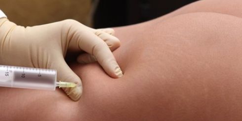 Эффект от процедуры мезотерапии. Реальный опыт