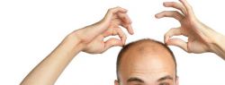 Почему происходит выпадение волос у мужчин