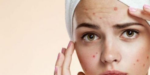 Всегда ли прыщи требуют консультации врача?