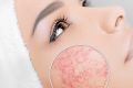 Как избавиться от капилляров на лице? Эффективные методы и советы