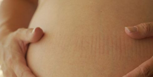 Кесарево сечение помогает избежать родовых комплексов и страхов